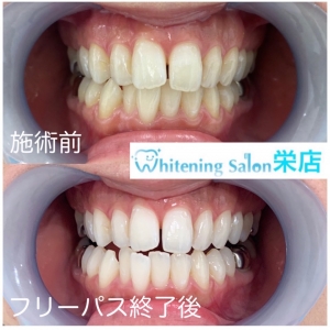 八重歯が可愛いのは日本だけ 名古屋ホワイトニングサロン栄本店 格安３回4 980円 歯のホワイトニング専門店
