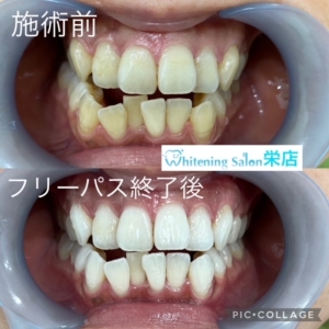 【歯周病のセルフチェック】