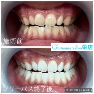 【大人の虫歯予防、虫歯のメカニズムと正しい対策方法】
