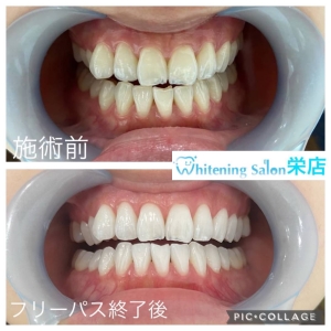 【ホワイトニング歯磨き粉で歯は白くなる？】