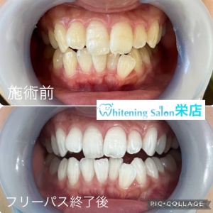 【乳歯は永久歯より白い？！】