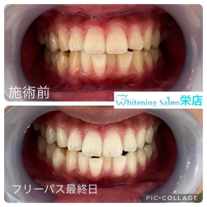【ホワイトニングの期間やどれくらい歯の白さが維持するのか】