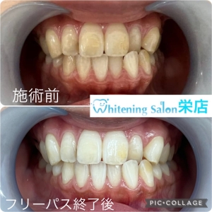【日本人の平均的な歯の色は黄色！？】