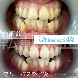 【オフィスホワイトニングの費用相場は？】