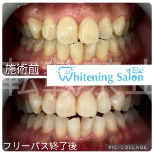 【ホワイトニング効果をフッ素が阻害する？】