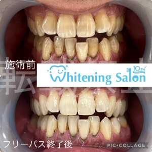 【歯磨きを忘れたらお口の中はどうなる？】