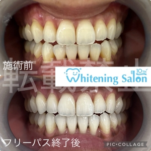 【歯の虫歯を予防するための食事習慣】