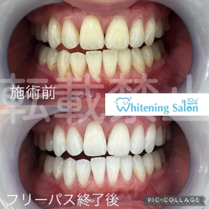 【抜けたままの歯があると全身に影響する？】