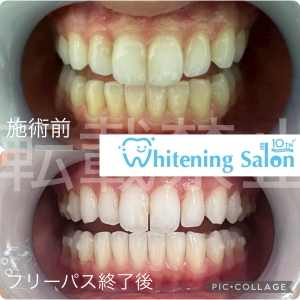 【歯の寿命を伸ばすためにできること】