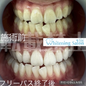 【虫歯になりやすい人って？】
