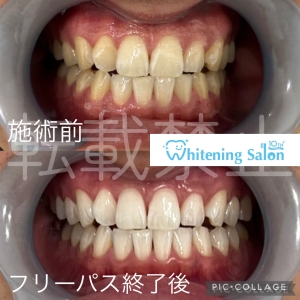 【アンチエイジングで歯も老化を防ぐ】