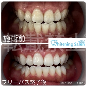 【親知らずは抜くべき？残すべき？】