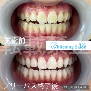 【不正咬合とは？】