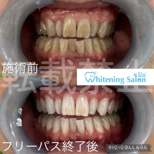 【強い歯を作るためには】