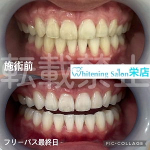 【歯肉の構造と唾液腺のしくみとは】