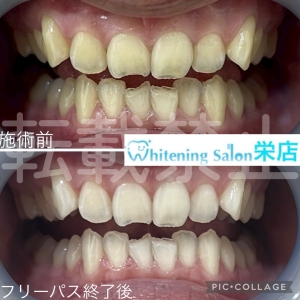 【歯が無くなる5つの習慣？！】