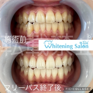 【タバコが口腔内に与える影響】