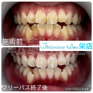 【大人の虫歯の原因と予防】