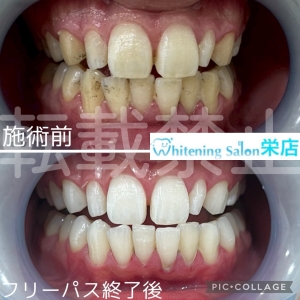 【歯茎が下がる原因と戻すための治療法とは】