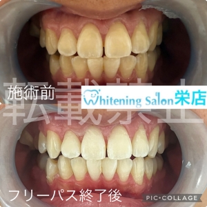 【食後すぐ歯磨きはNG?正しい口腔ケアのタイミング】