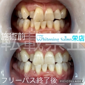 【マスク生活と口臭の関係】