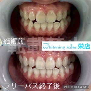 【気になる歯の黄ばみの正体】