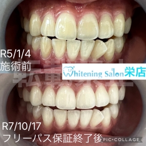 【タバコがもたらすお口の中の悪影響】