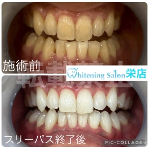 【歯ぎしりがもたらすお口への悪影響】