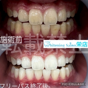 【歯を失う本数や年齢とは】