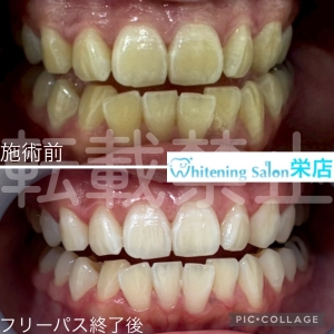 【子供の歯はいつ大人の歯に生え変わる？】