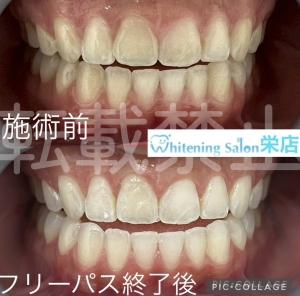 【歯と骨の違いとは】名古屋栄/ホワイトニング