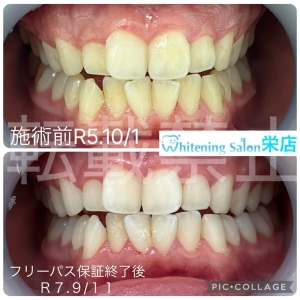 【冬に歯がしみみやすくなる理由】