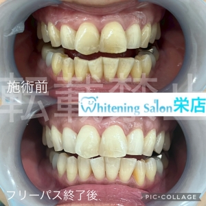【歯を失う原因第一位「歯周病」】