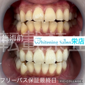 【歯の黄ばみの原因と対策】