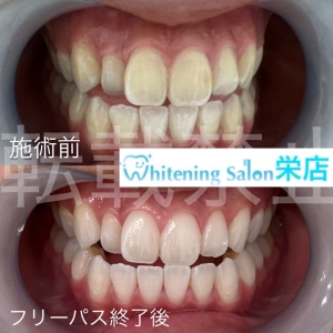 【お口の中のpHバランスを保つには？】名古屋栄/ホワイトニング