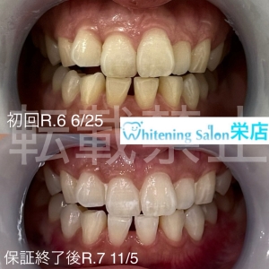 【歯の健康を守る食べ物】名古屋栄/ホワイトニング