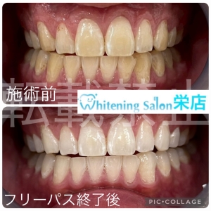 【歯の寿命を縮める意外な習慣】名古屋栄/ホワイトニング