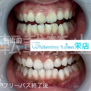 【お口に潜む『バイオフィルム』とは？】名古屋栄/ホワイトニング