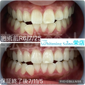 【ブラックトライアングルとは】名古屋栄/ホワイトニング