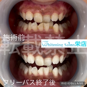 【虫歯で歯に穴が開くとどうなる？】名古屋栄/ホワイトニング