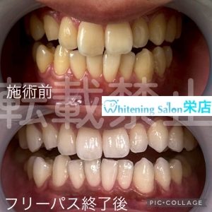 【歯のセラミック治療と種類とは】名古屋栄/ホワイトニング