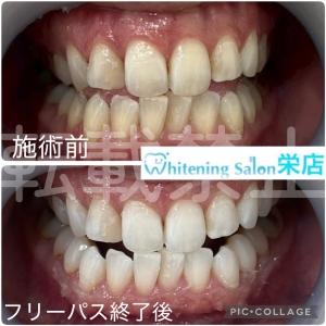 【炭酸水で歯は溶けるのか？】名古屋栄/ホワイトニング