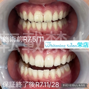 【35歳以上から増える大人の虫歯】名古屋栄/ホワイトニング