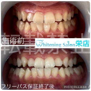 【歯が白くなる食べ物・黄ばむ食べ物】名古屋栄/ホワイトニング