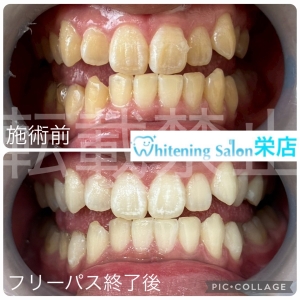 【歯並びが悪いと虫歯になりやすい】名古屋栄/ホワイトニング