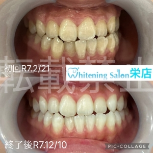 【ホワイトニングとクリーニングの違い】名古屋栄/ホワイトニング