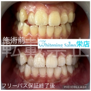 【虫歯菌はうつる？】名古屋栄/ホワイトニング