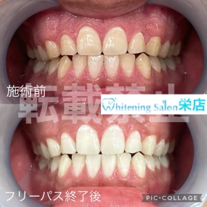 【親知らず、抜く？抜かない？】名古屋栄/ホワイトニング