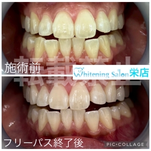 【健康な歯茎の見分け方】名古屋栄/ホワイトニング