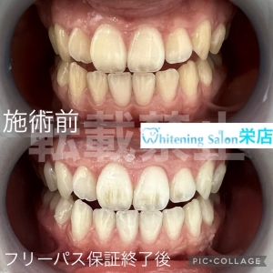 【歯ブラシで取れる汚れは６割！？】名古屋栄/ホワイトニング